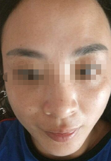 眉毛上方两个鼓包面相【两眉中间有鼓包面相上可好】