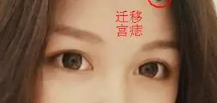 双生痣是什么意思,可以去掉吗【双生痣点掉会有什么影响】