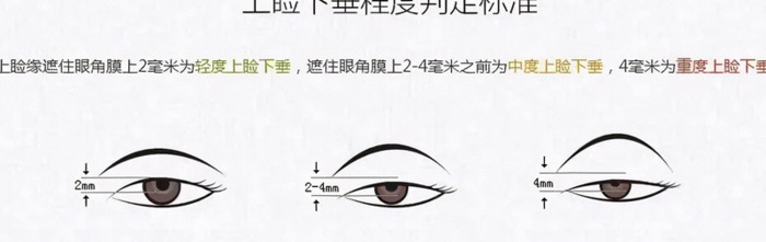 眼部整形培训【眼部整形术】