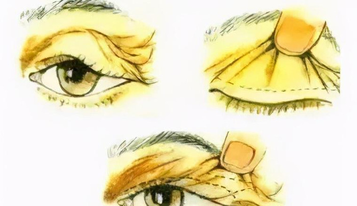 眼部整形培训【眼部整形术】