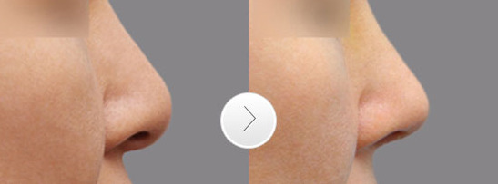 山根低就一定不好看吗【山根低有什么坏处】