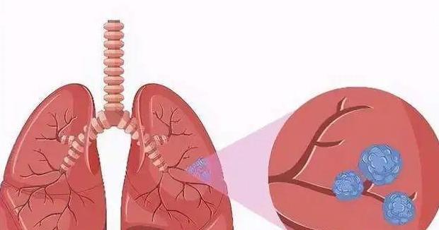 肺结节胸腔镜微创手术过程【肺结节做胸腔镜手术】