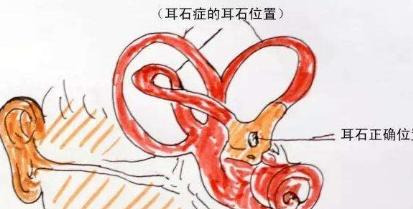 耳石症的自我治疗方法【耳石症快速缓解方法】