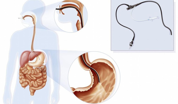 做肠镜姿势怎么样的【病人做肠镜的姿势图片】