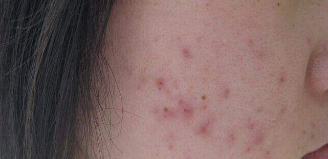 hnsw水杨酸面膜怎么样知乎【hnsw水杨酸面膜】