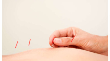 学针灸哪里最好【针灸理疗培训哪里好】