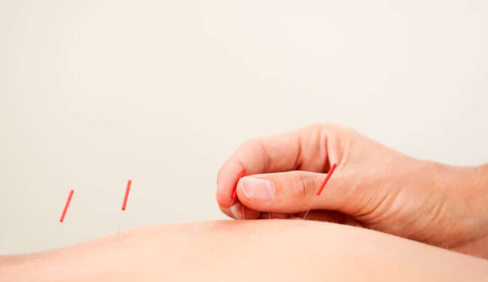 学针灸哪里最好【针灸理疗培训哪里好】