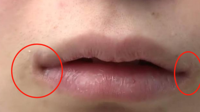 嘴角上扬整形多少钱【嘴角上扬术】