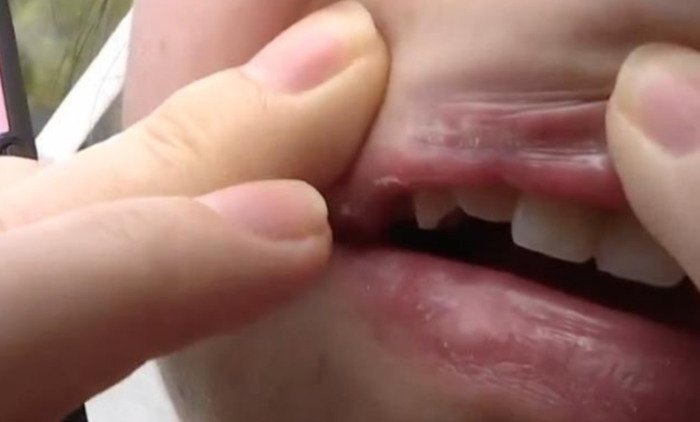 嘴角上扬整形多少钱【嘴角上扬术】