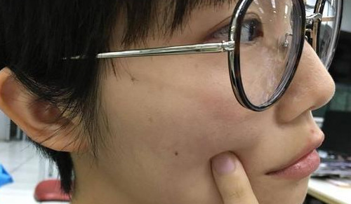 侧脸靠近耳朵附近有痣好不好【侧脸靠近耳朵附近有痣代表什么】