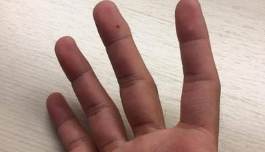 侧脸靠近耳朵附近有痣好不好【侧脸靠近耳朵附近有痣代表什么】