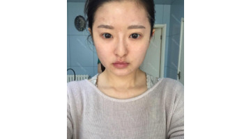 拉眼角会有什么危害【提拉眼角手术】