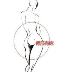 耳轮上长痣代表什么女【女的耳轮有痣】