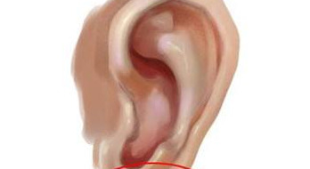 耳轮上长痣代表什么女【女的耳轮有痣】